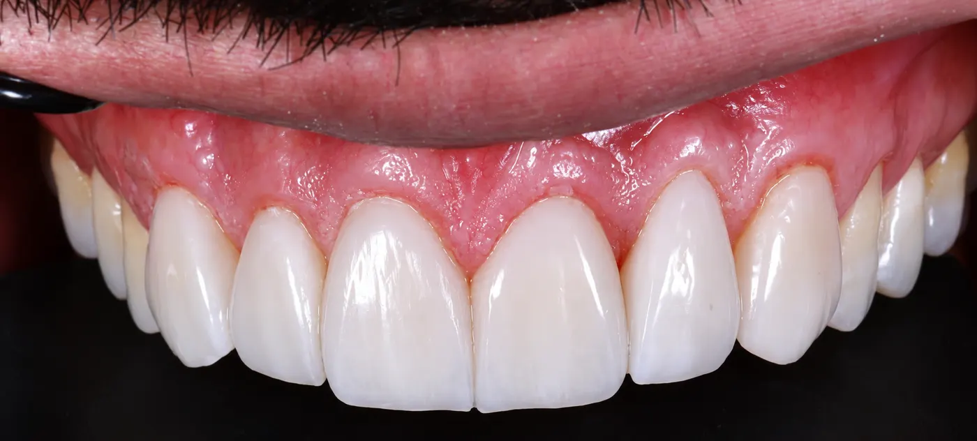 Close-up of upper porcelain veneers